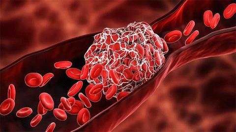 Blood Clotting Disorders Types, Sym